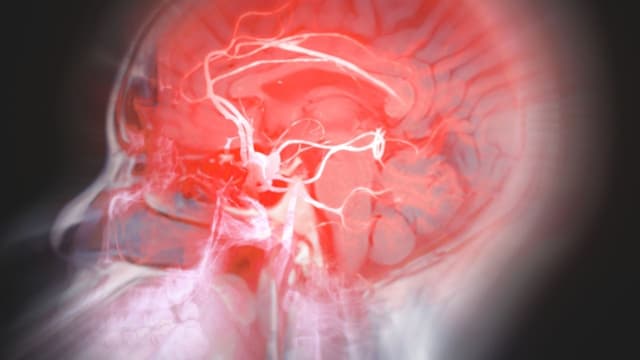 Tầm soát dị dạng mạch máu não thế nào?