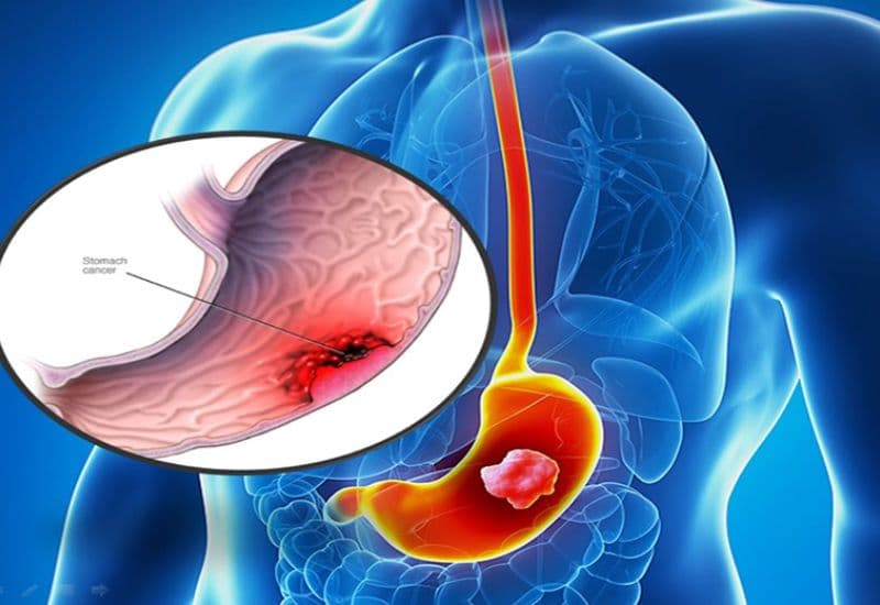 tầm soát ung thư tiêu hóa