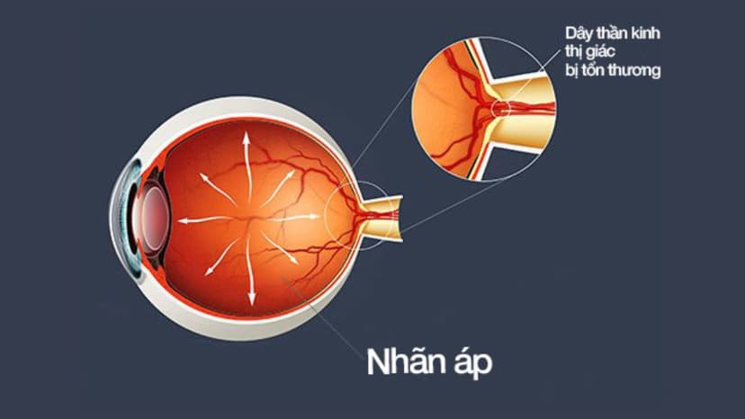 Vì sao tăng nhãn áp nguy hiểm?