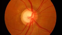 Tăng nhãn áp góc đóng và mở là gì?