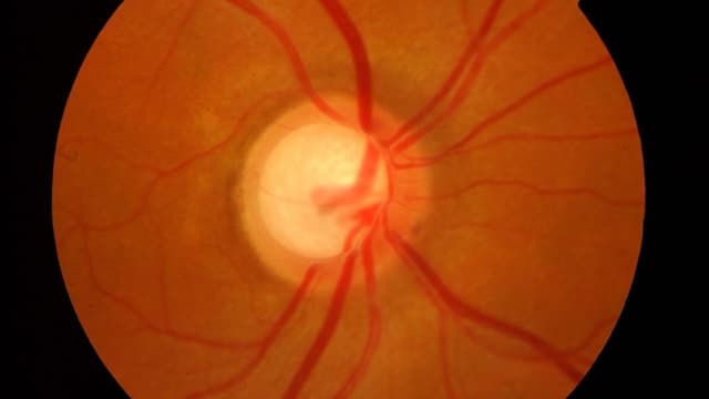 Tăng nhãn áp góc đóng và mở là gì?