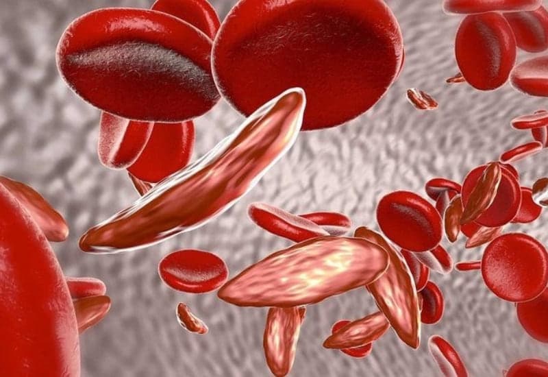 hồng cầu có nhân tế bào bất thường