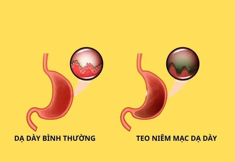 teo niêm mạc dạ dày có nguy hiểm không