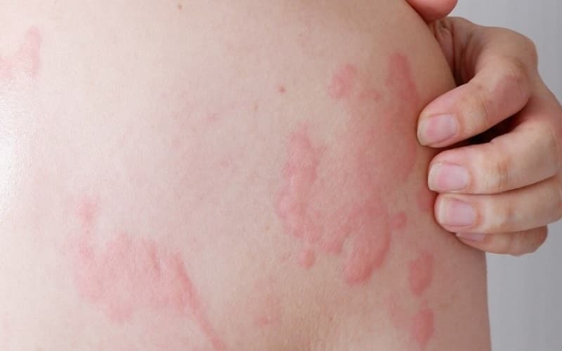 nổi mề đay có tự hết không