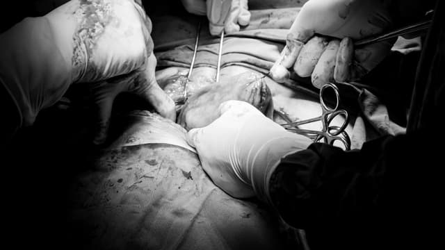 Chỉ định mổ u xơ tử cung trong những trường hợp nào?