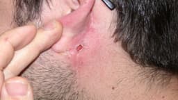 Mổ rò luân nhĩ có để lại sẹo không và câu trả lời từ chuyên gia