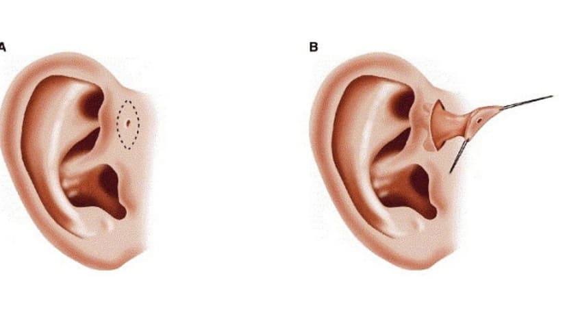 Biểu hiện bệnh rò luân nhĩ ở người lớn và những điều cần biết