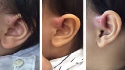 Vì sao lỗ rò luân nhĩ có mùi hôi và chảy mủ?