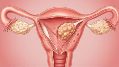 Liên quan giữa estrogen và u xơ tử cung