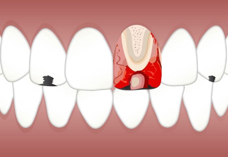 thuốc diệt tủy răng có độc không
