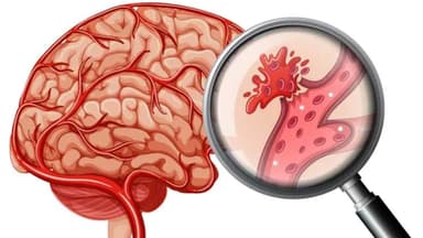 Tiêu chuẩn chẩn đoán nhồi máu não