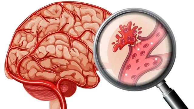 Tiêu chuẩn chẩn đoán nhồi máu não