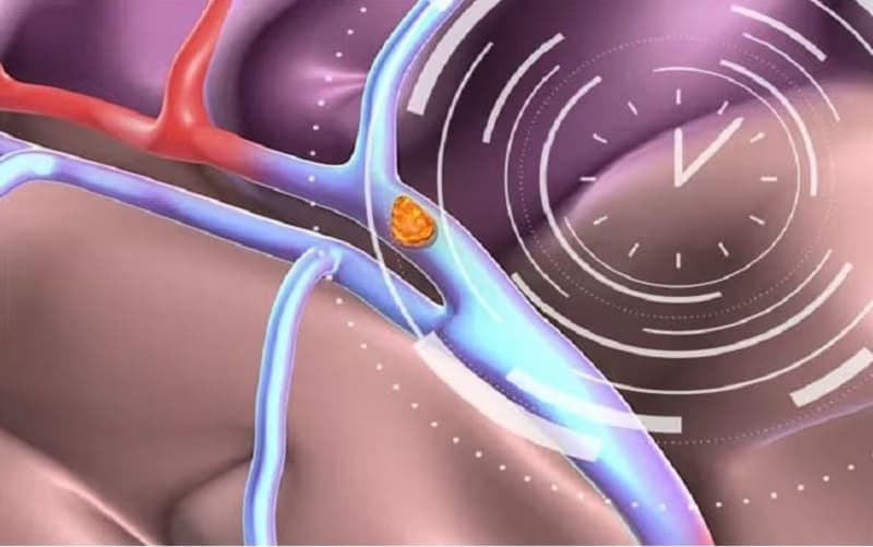 chỉ định tiêu sợi huyết trong nhồi máu não