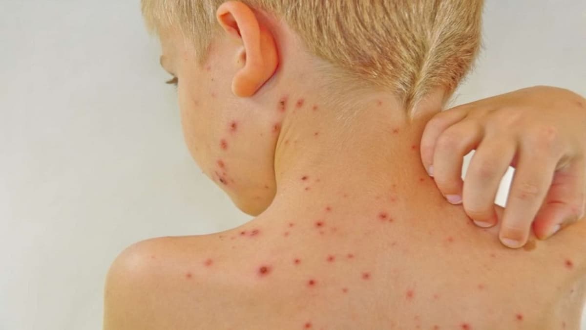 Triệu chứng sốt siêu vi ở trẻ em dễ nhầm lẫn