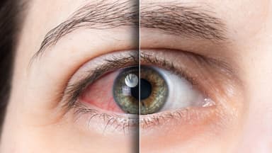 Các triệu chứng tăng nhãn áp điển hình