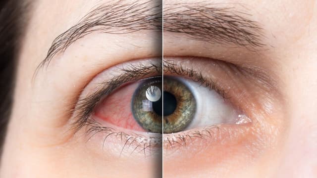 Các triệu chứng tăng nhãn áp điển hình