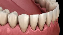 Tụt chân răng là gì? Tụt chân răng phải làm sao?