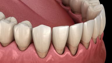 Tụt chân răng là gì? Tụt chân răng phải làm sao?