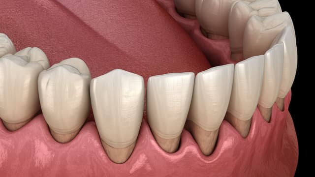 Tụt chân răng là gì? Tụt chân răng phải làm sao?