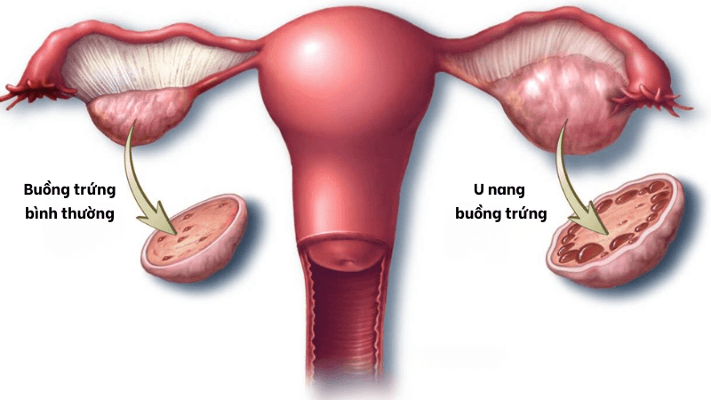 u nang buồng trứng là bị gì