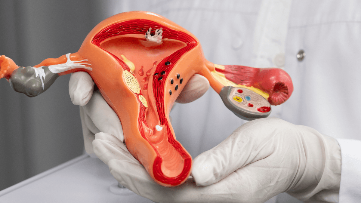 U nang buồng trứng là bị gì? Biểu hiện?