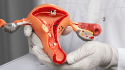 U nang buồng trứng là bị gì? Biểu hiện?