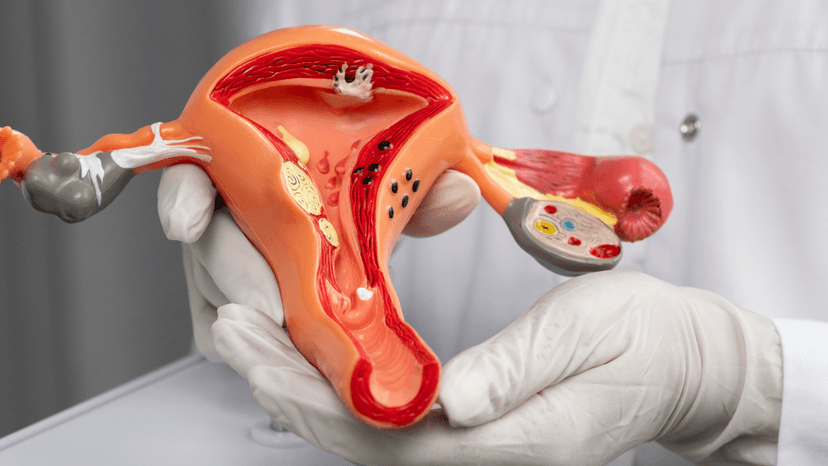 U nang buồng trứng là bị gì? Biểu hiện?