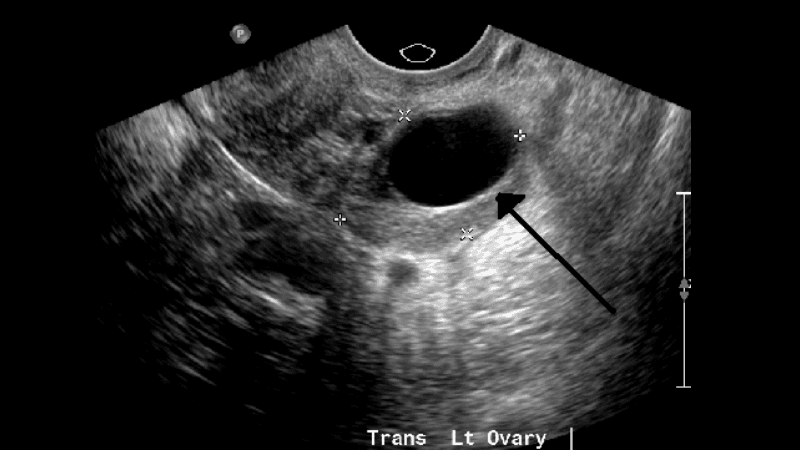 u nang buồng trứng siêu âm có thấy không