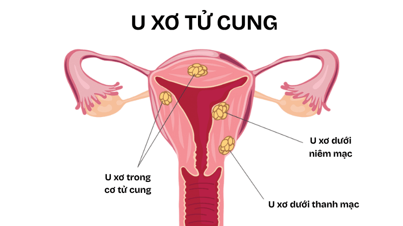 u xơ tử cung gây chảy máu