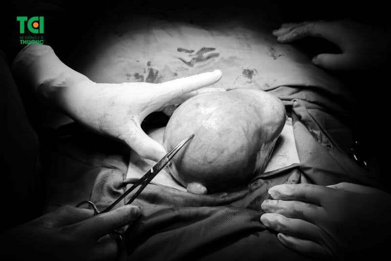 u xơ tử cung phát triển nhanh