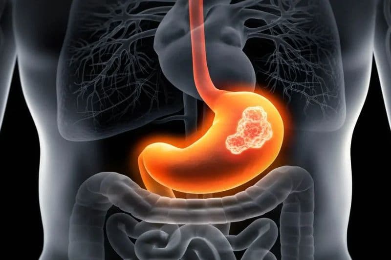 ung thư biểu mô dạ dày giai đoạn sớm