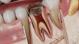 Viêm tủy răng có tự hết không?