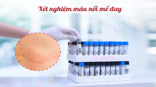 Chỉ định xét nghiệm máu nổi mề đay