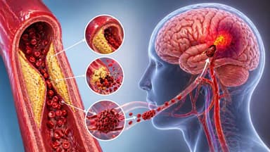Xơ vữa mạch máu là gì và liên quan thế nào tới nguy cơ đột quỵ?
