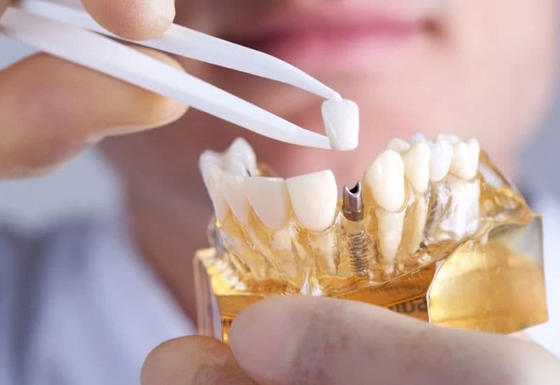 15 tuổi trồng răng được không