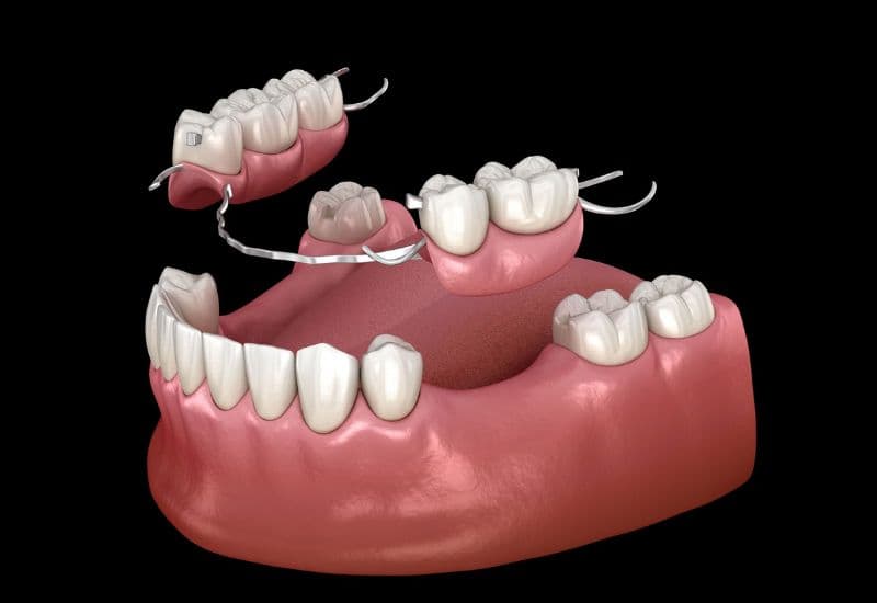 15 tuổi trồng răng được không