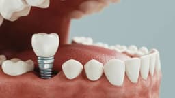 15 tuổi trồng răng được không?