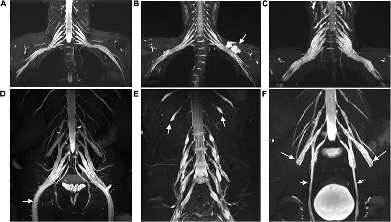 chỉ định chụp mri cột sống cổ