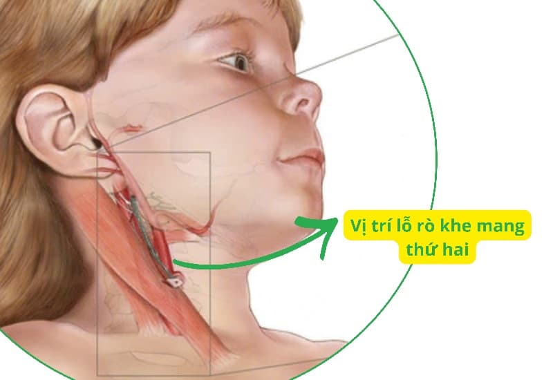 chỉ định chụp mri cột sống cổ