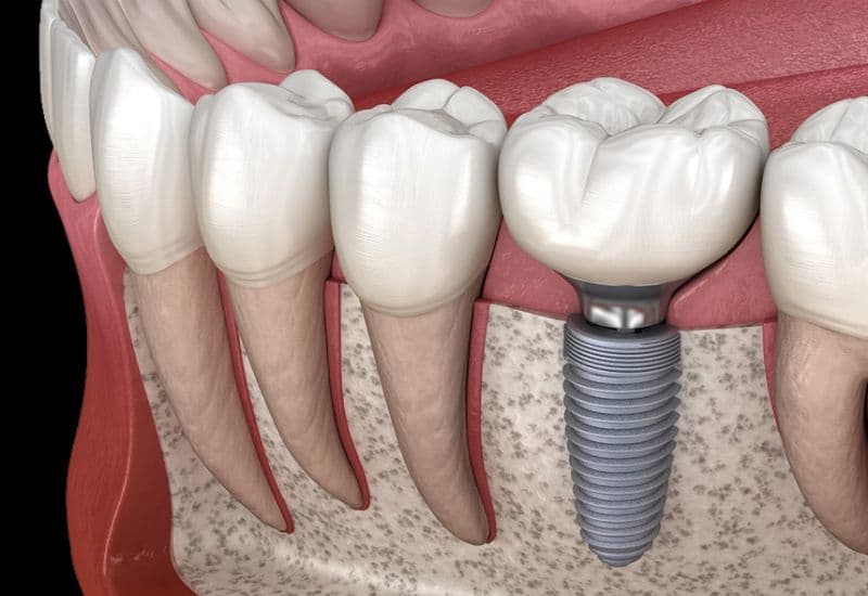 60 tuổi có nên trồng răng không