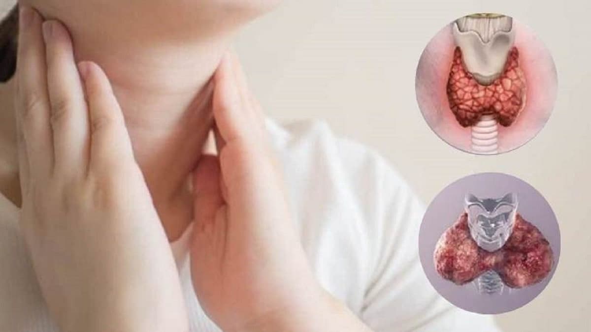 Áp xe tuyến giáp ở trẻ em có nguy hiểm?