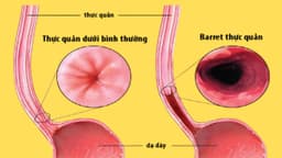 Barrett thực quản là gì? Có thấy rõ dưới nội soi?