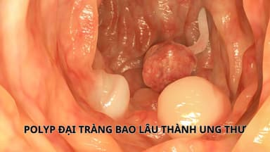 Polyp đại tràng bao lâu thành ung thư?