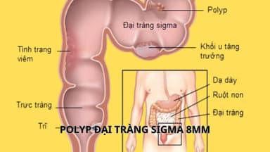 Polyp đại tràng sigma 8mm có nhìn rõ dưới nội soi?