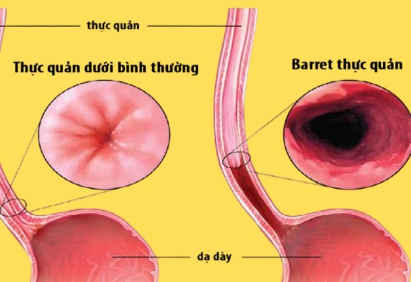 barrett thực quản là gì