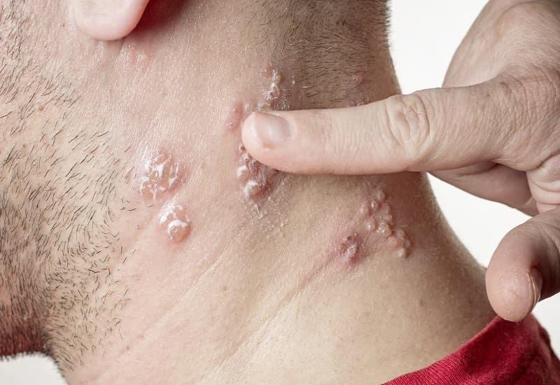 bệnh lậu có dễ chữa không