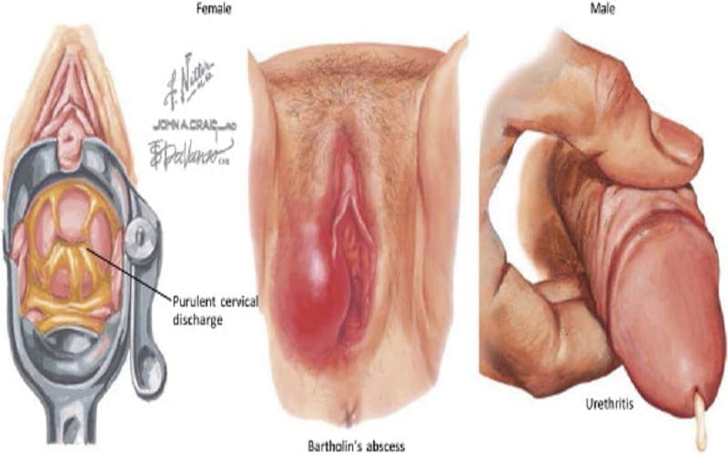 vi khuẩn gây bệnh lậu