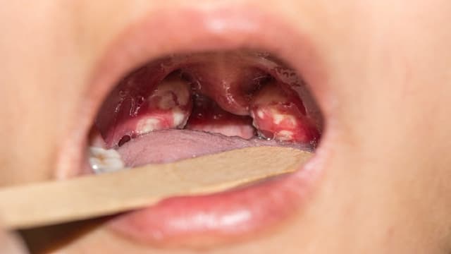 Bệnh lậu có ủ bệnh không? Lây trong bao lâu?