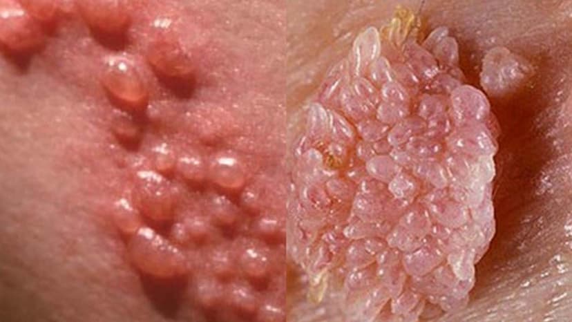 Bị bệnh sùi mào gà bao lâu phát bệnh