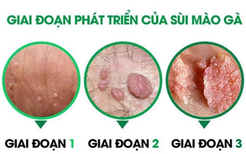 bệnh sùi mào gà bao lâu phát bệnh